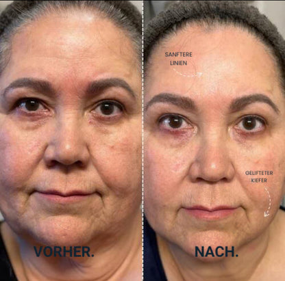 Vitalità ClearSkin Pro