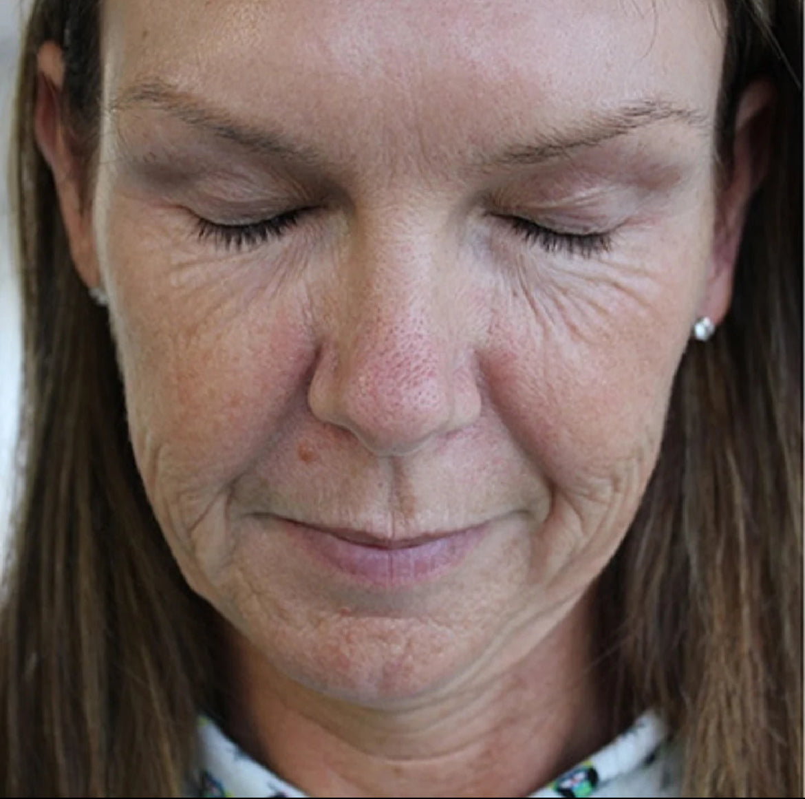 Vitalità ClearSkin Pro